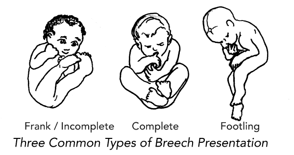 Breech-3-types