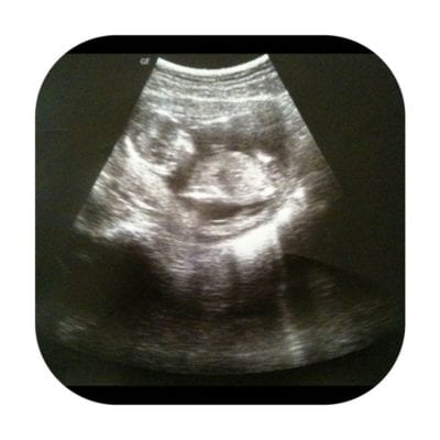 sonogram picture of baby